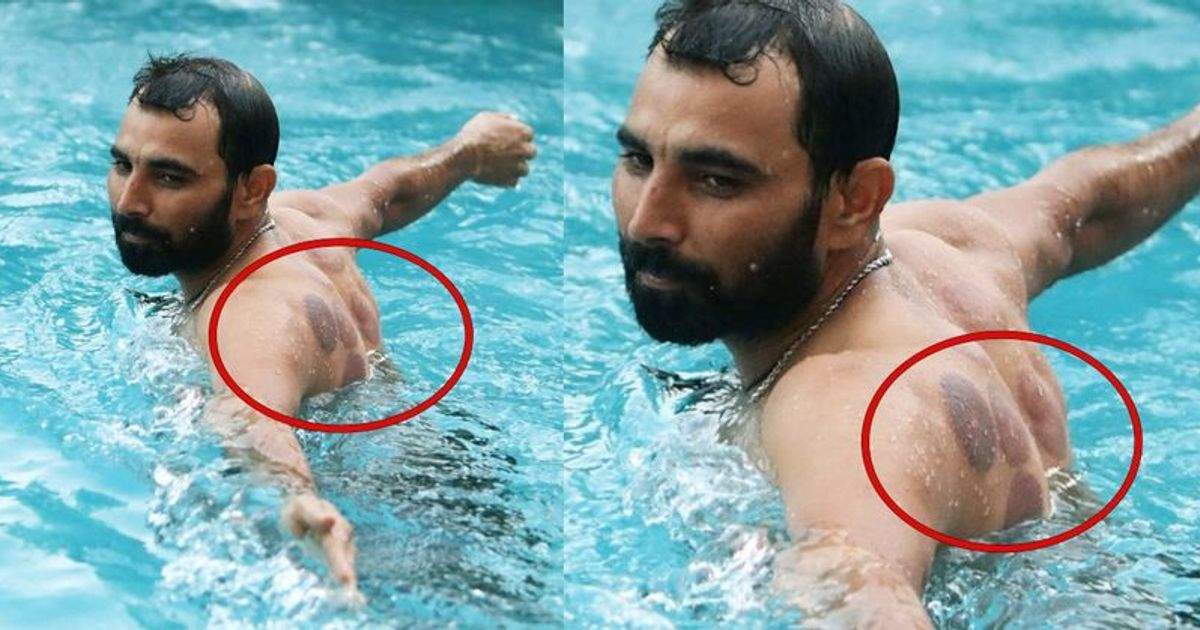 Here’s the reason why Mohammed Shami’s back is covered in reddish-black circles